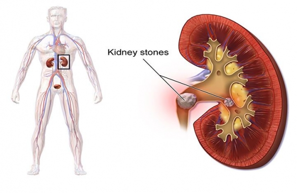 Sababu za kutokea vijiwe katika Figo
