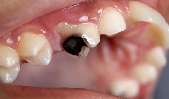 Kuoza kwa meno (Dental Caries) ni ugonjwa wa kuambukiza