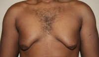 Tatizo la Kuota Matiti kwa Wanaume na Watoto (Gynecomastia)