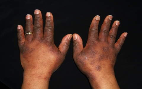 Ugonjwa wa contact dermatitis
