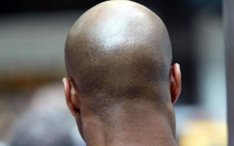 Alopecia (Tatizo la Kunyonyoka Nywele)