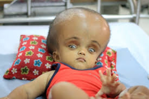 Kichwa Maji (Hydrocephalus)