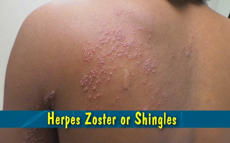 Mkanda wa Jeshi (Herpes Zoster/Shingles)